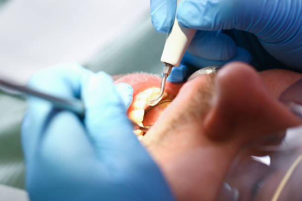 Best Emergency Wisdom Teeth Removal in Brownsville, LA